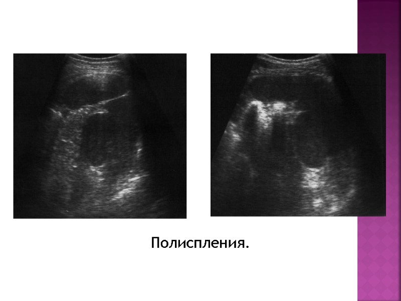 Полиспления.
